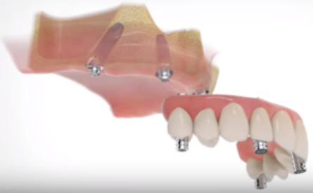 All On Four Dental Implants Long Island business image